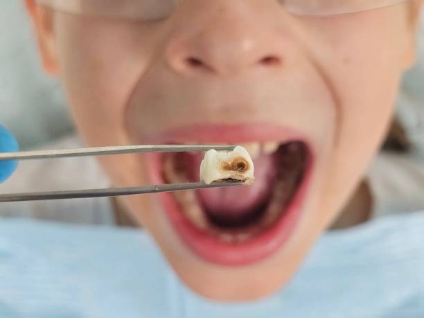 Best Broken or Cracked Tooth Emergency Dentist in Bethesda, OH